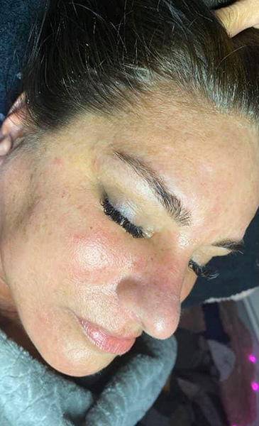 Botox facial
